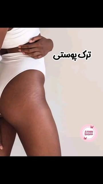 کرم رفع ترک بدن گاتیو (استرچ مارک )